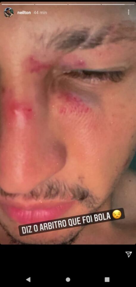 Sport: Neílton ironiza e mostra cortes no rosto após clássico; veja foto 1 Posts